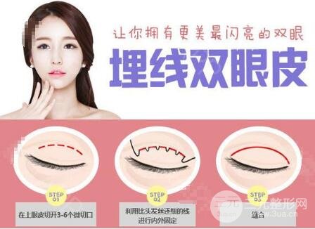 埋线和纳米微创的区别