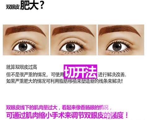 双眼皮严重肉条修复