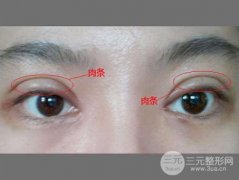 双眼皮肉条严重的图片分享 遇到了别慌，还能修复！