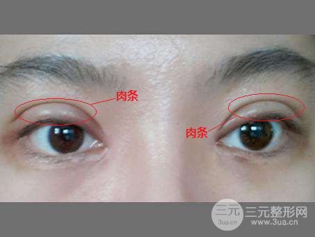 双眼皮肉条严重的图片