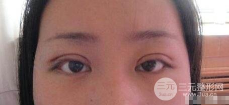 双眼皮肉条严重的图片