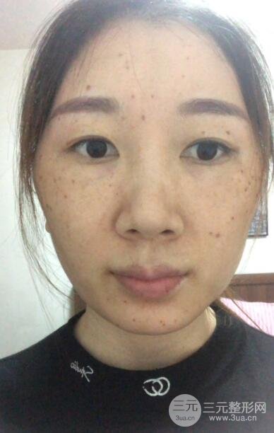 点阵激光后恢复过程图