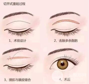 全切双眼皮手术原理