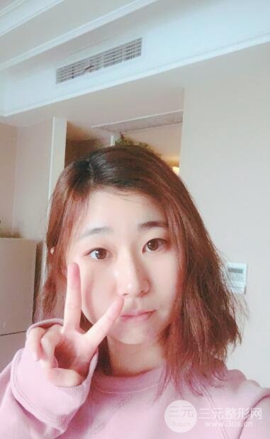 双眼皮手术案例
