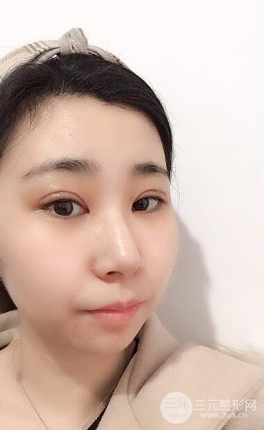 双眼皮手术案例