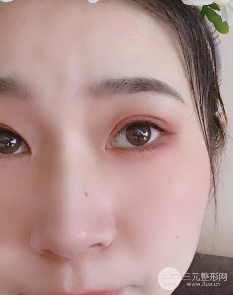 双眼皮手术案例