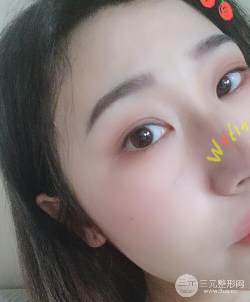 双眼皮手术案例