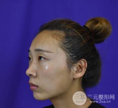 双眼皮手术案例反馈