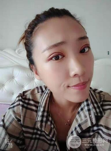 双眼皮手术案例反馈