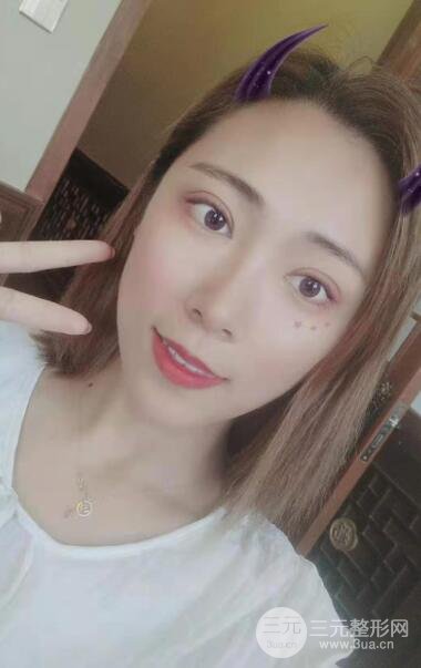 双眼皮手术案例反馈