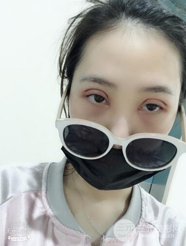 双眼皮手术+开眼角案例