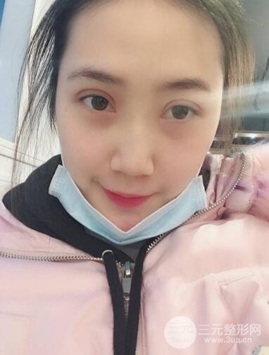 双眼皮手术+开眼角案例