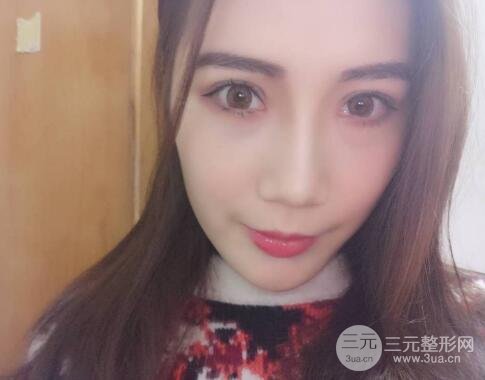 双眼皮手术+开眼角案例