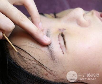 纳米微创双眼皮案例