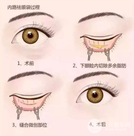 吸脂去下眼袋会留疤吗