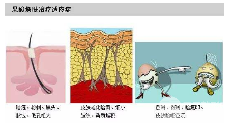 敏感肌别做果酸活肤缓解