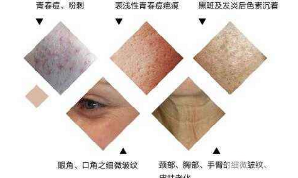 敏感肌别做果酸活肤缓解