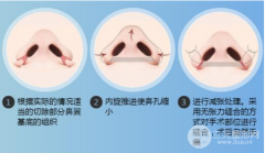 鼻翼缩小术费用贵吗?大鼻头女孩来查收你的美鼻攻略! 鼻翼缩小术费用贵吗?大鼻头女孩来查收你的美鼻攻略!