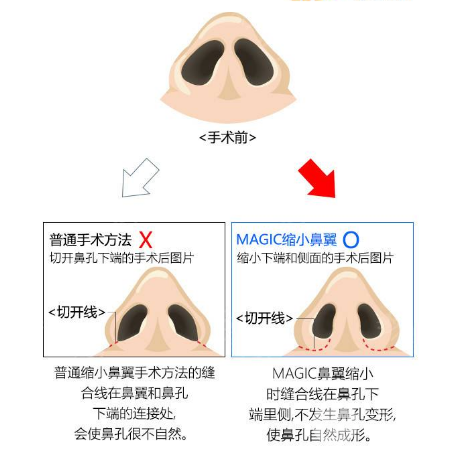 鼻翼缩小术费用
