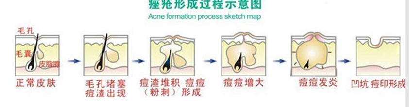 激光缓解痤疮价格