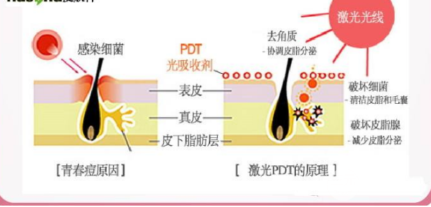 激光缓解痤疮价格