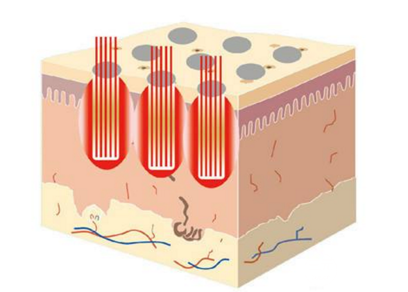 激光缓解痤疮价格
