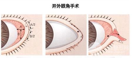 眼角开大了能回缩吗？附术前术后注意事项大全~