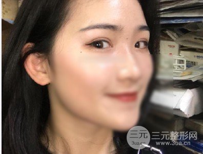 开眼角前后对比照片