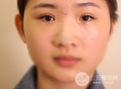 开眼角前后对比照片