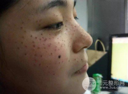 去痣多少钱一颗