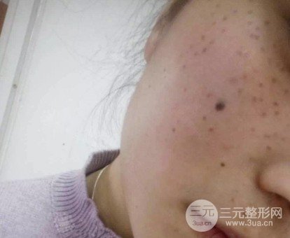 去痣多少钱一颗