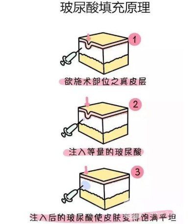 玻尿酸填充泪沟能保持多久