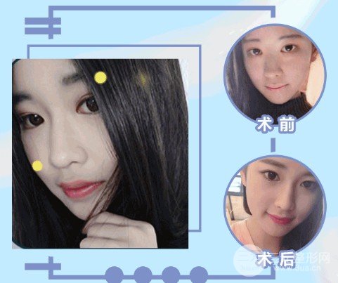 假体隆鼻