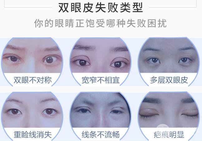 双眼皮失败的八种图片