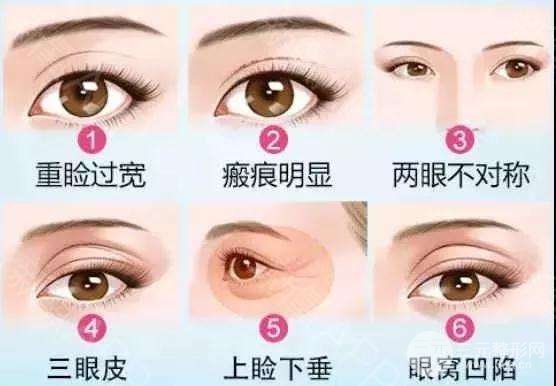 双眼皮失败的八种图片