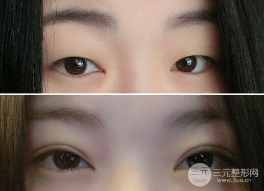 开眼角为什么显老