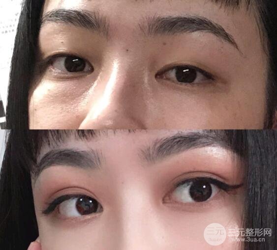 双眼皮6 7 8毫米果图