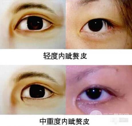不适合开眼角眼型图片