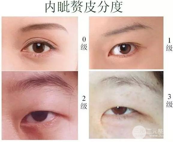适合开眼角的眼睛图解