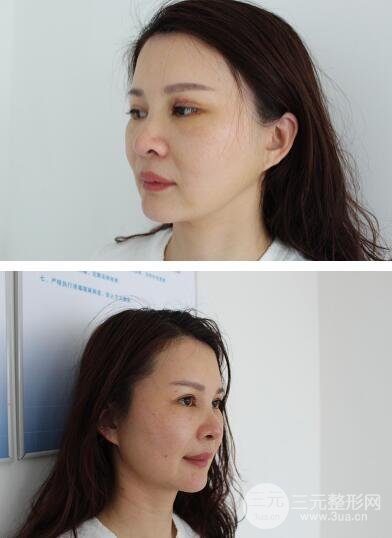 拉皮手术案例