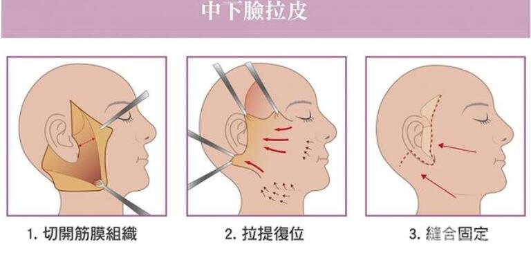 拉皮手术以后好难看怎么回事?