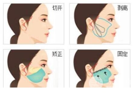 拉皮手术可以维持几年?