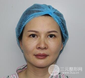 拉皮手术案例