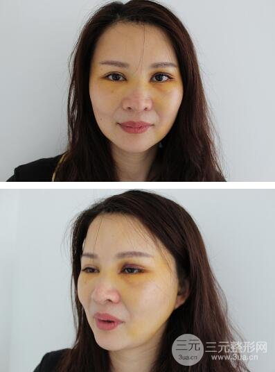 拉皮手术以后好难看怎么回事拉皮注意事项拉皮手术案例