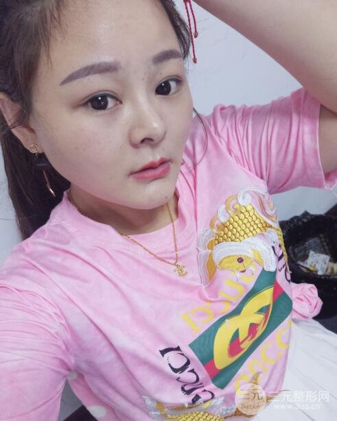 做完拉皮手术3天