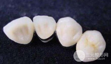 烤瓷牙果好不好?