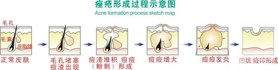 痤疮激光缓解多少钱