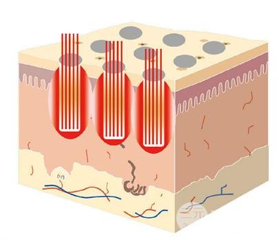 痤疮激光缓解多少钱