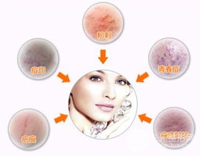 痤疮激光缓解多少钱