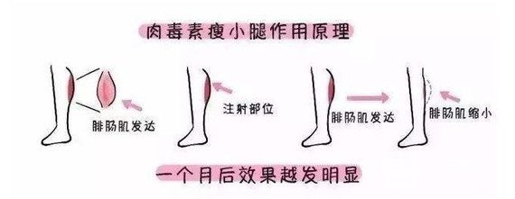 注射瘦腿果